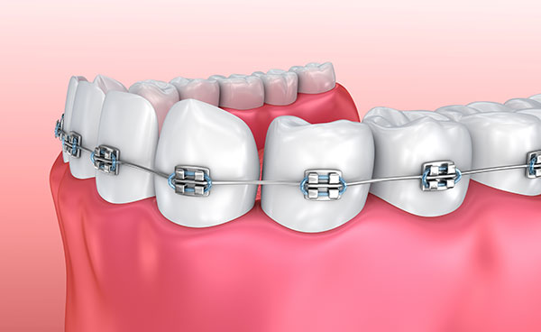 How Do Braces Work In Orthodontics To Straighten Teeth?