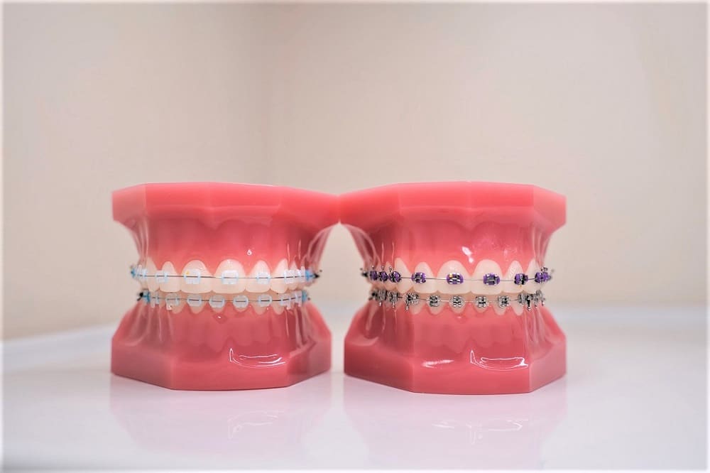 braces for lower teeth