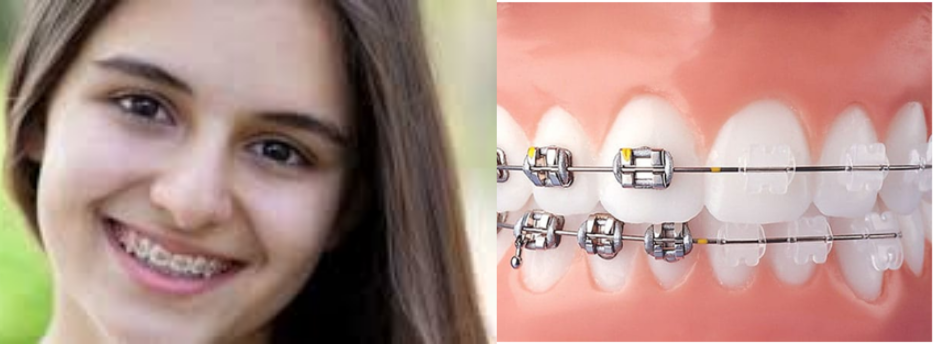 How Do Teeth Braces Help in Correcting Misalignment?