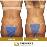 Liposuction Houston