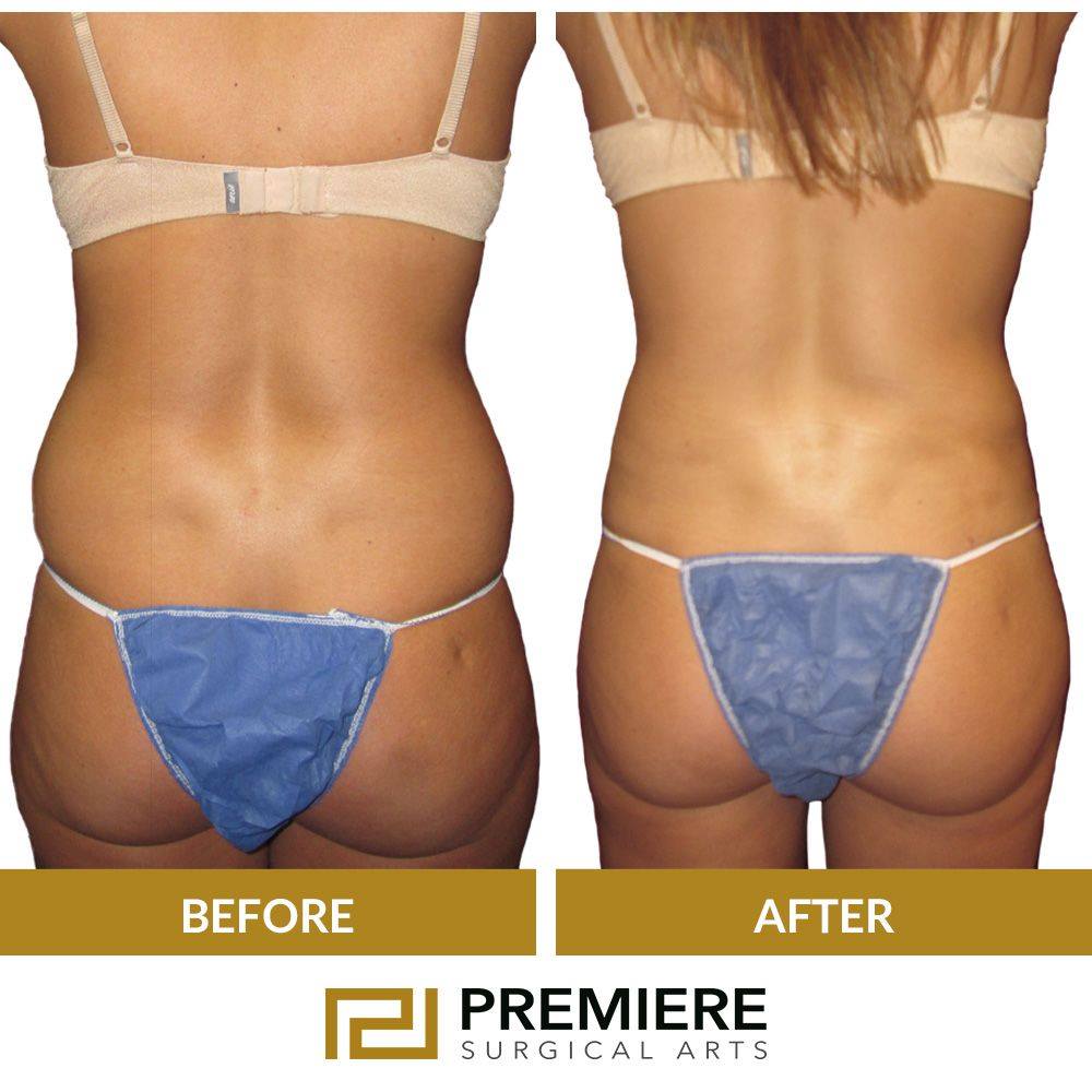 Is Liposuction in Houston Key to Achieving a Perfect Contour