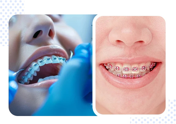 What is the Cost of Braces in Jaipur and How Do Invisalign Teeth Braces Compare?