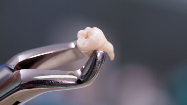 Understanding Wisdom Tooth Removal: What You Need to Know